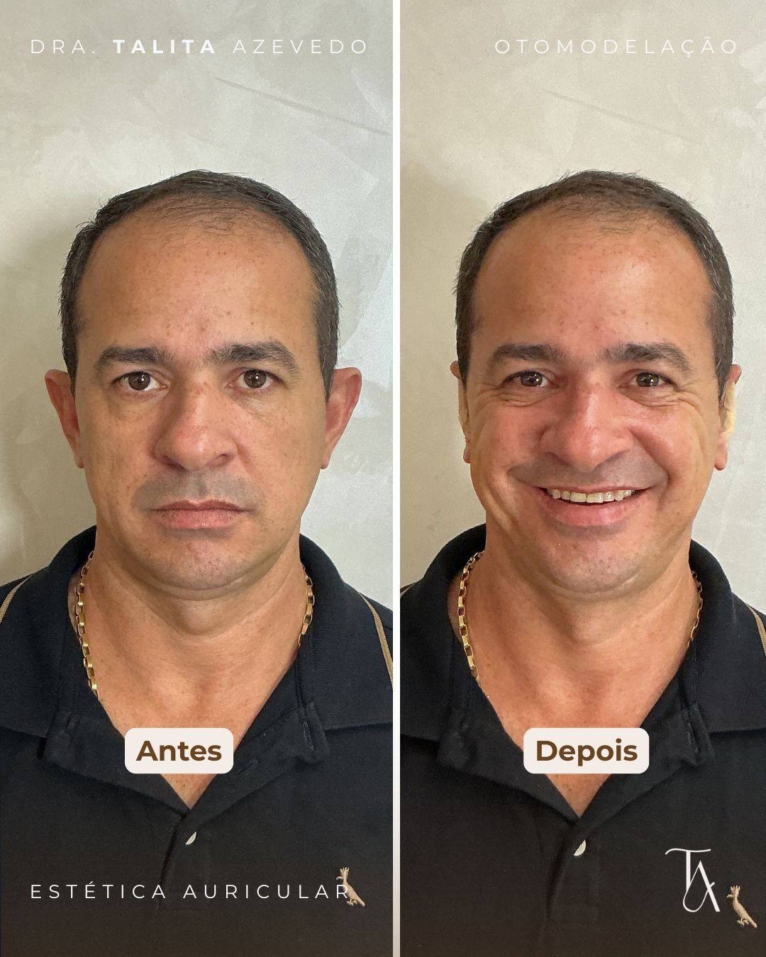 Antes e depois de Otomodelação — paciente 1