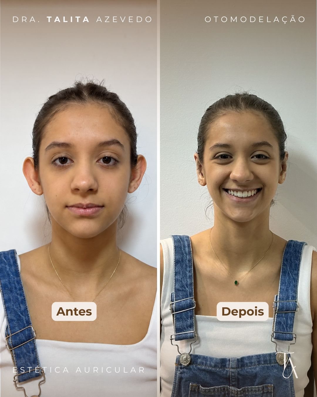 Antes e depois de Otomodelação — paciente 2