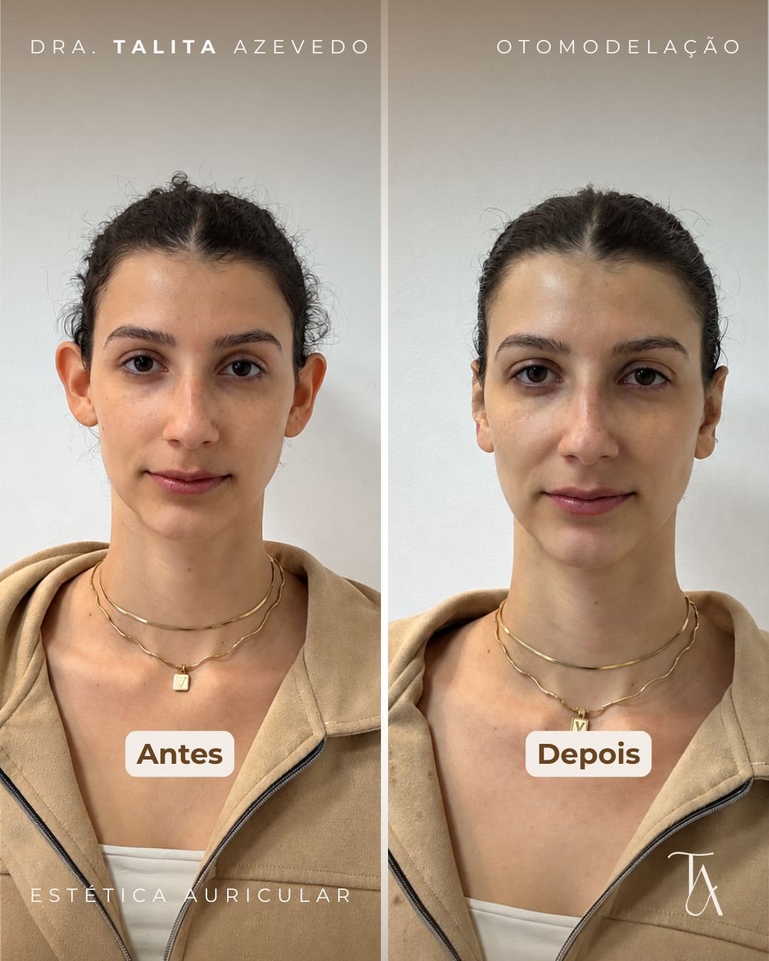 Antes e depois de Otomodelação — paciente 3