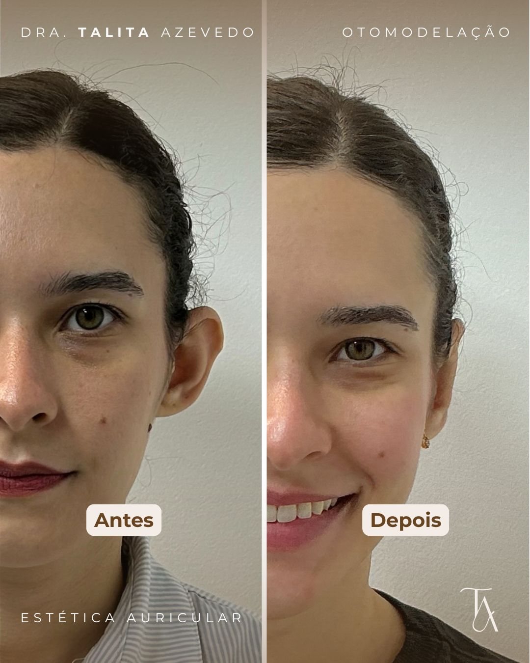 Antes e depois de Otomodelação — paciente 4