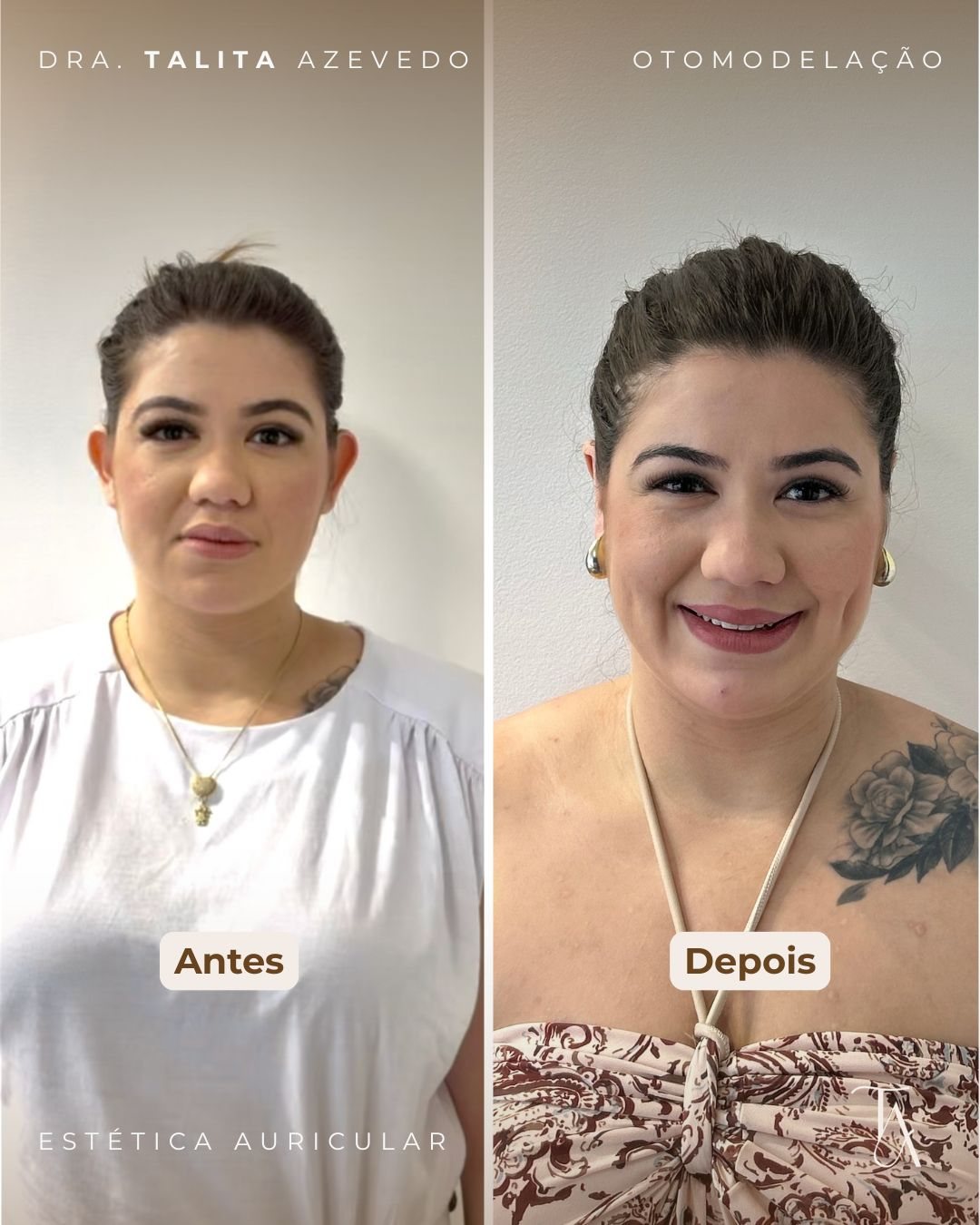 Antes e depois de Otomodelação — paciente 5