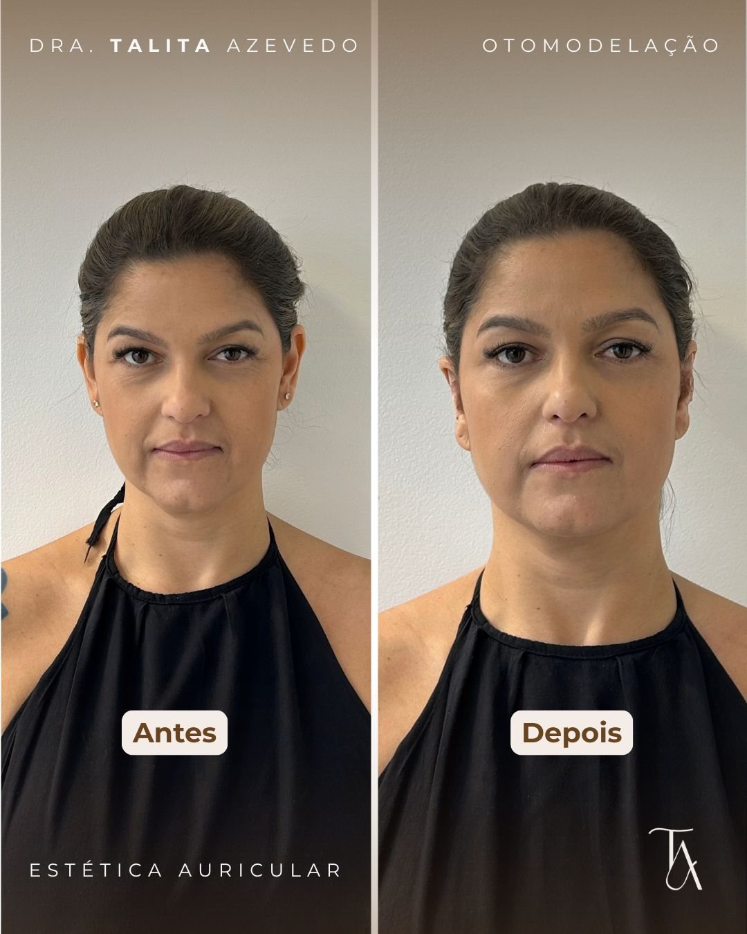 Antes e depois de Otomodelação — paciente 6